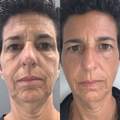 ivi collagen before and after